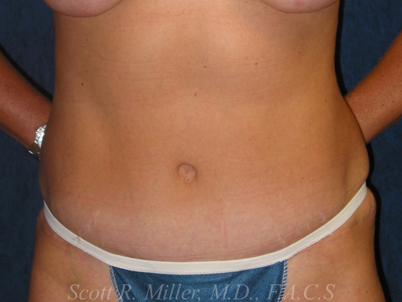 Tummy Tuck before and after - after