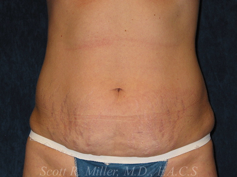 Tummy Tuck before and after - before