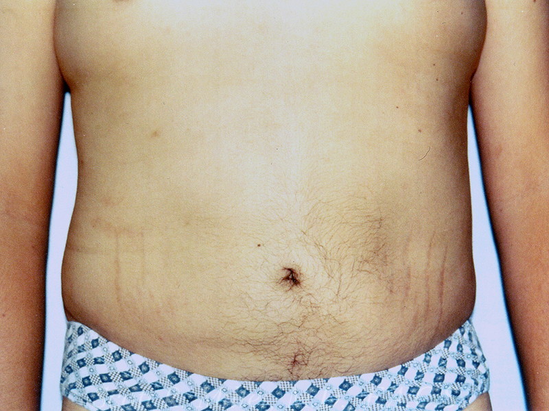 Liposuction before and after - after