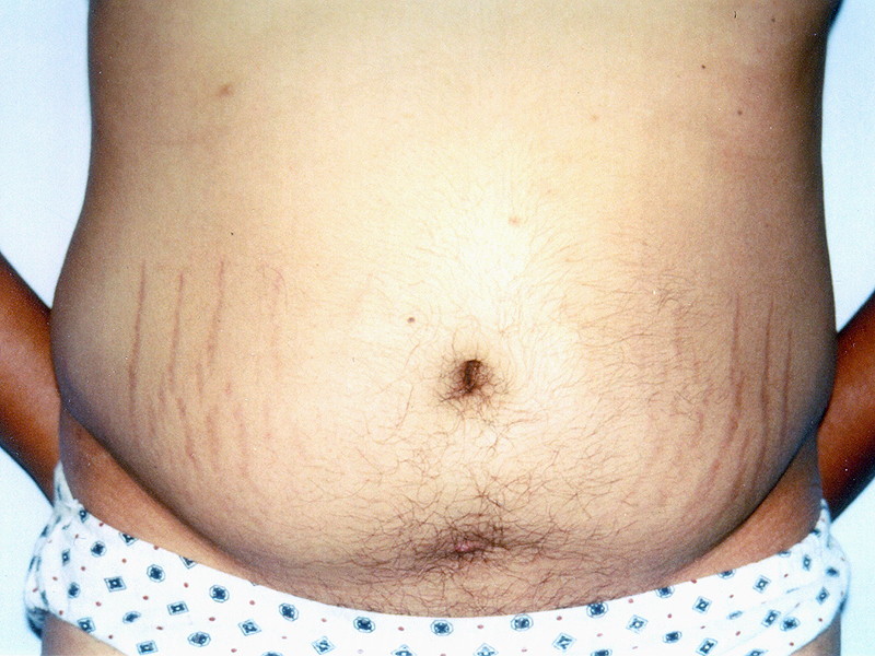 Liposuction before and after - before