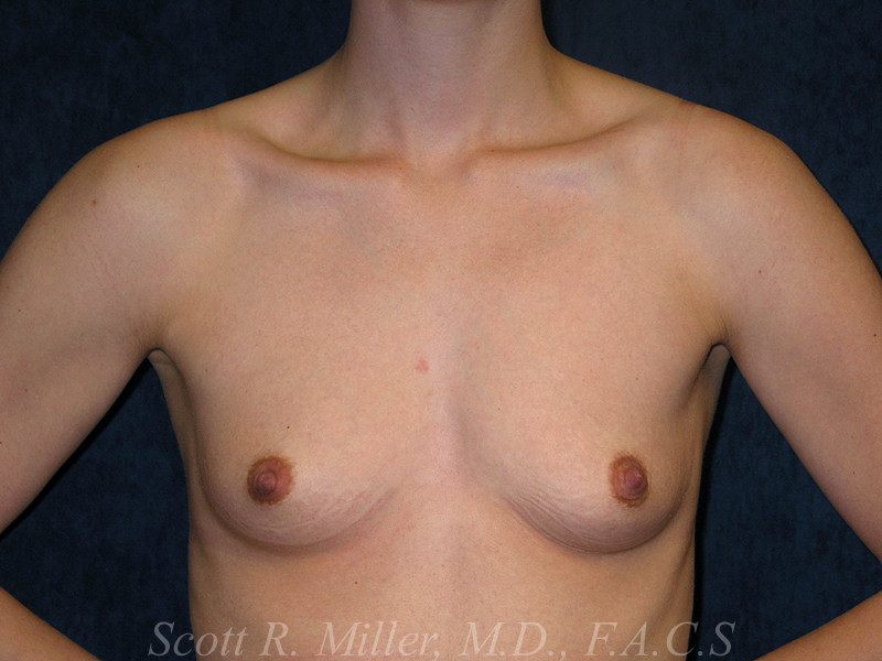 Breast Augmentation before and after - before