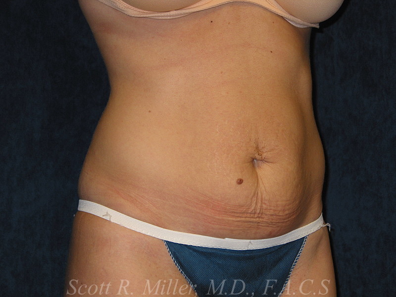 Tummy Tuck before and after - before
