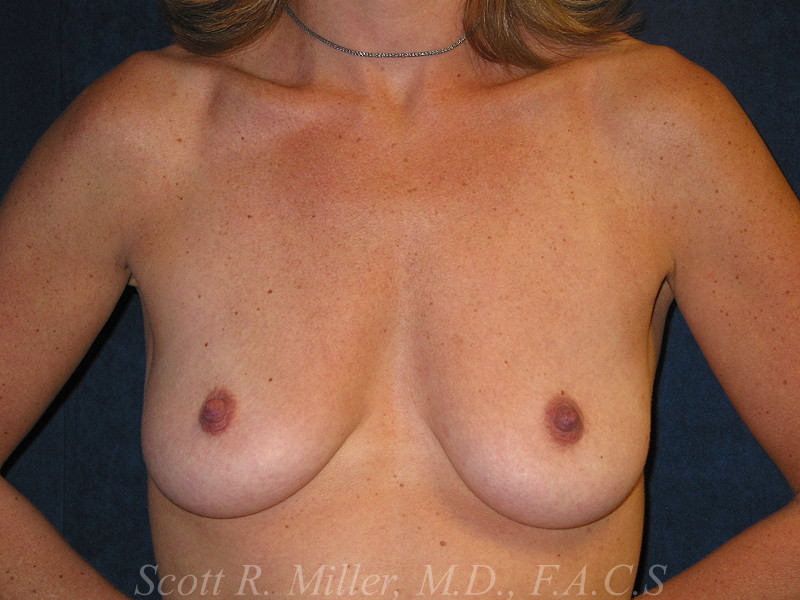 Breast Lift with Implants before and after - before