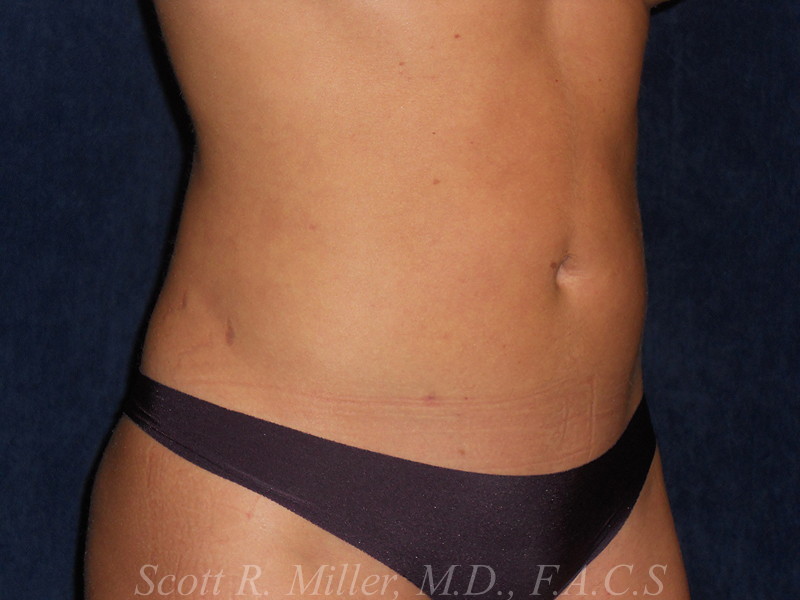 Liposuction before and after - after