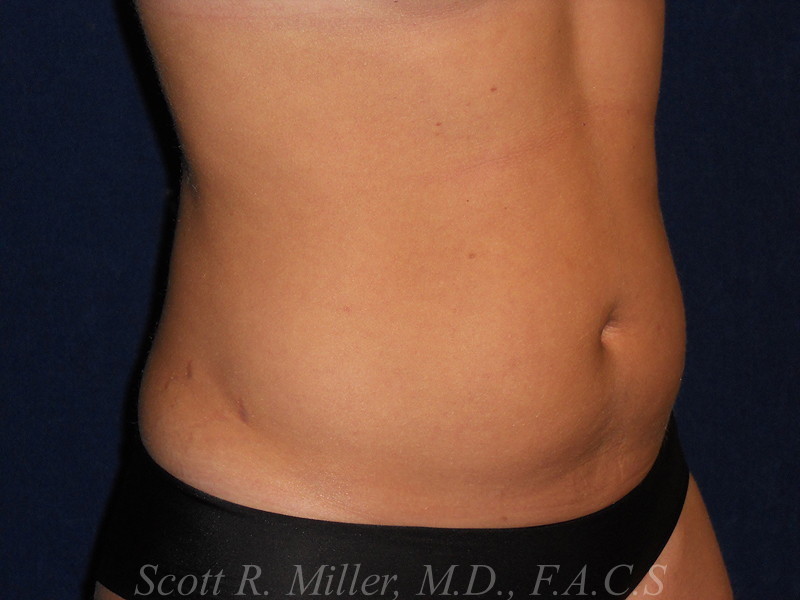 Liposuction before and after - before