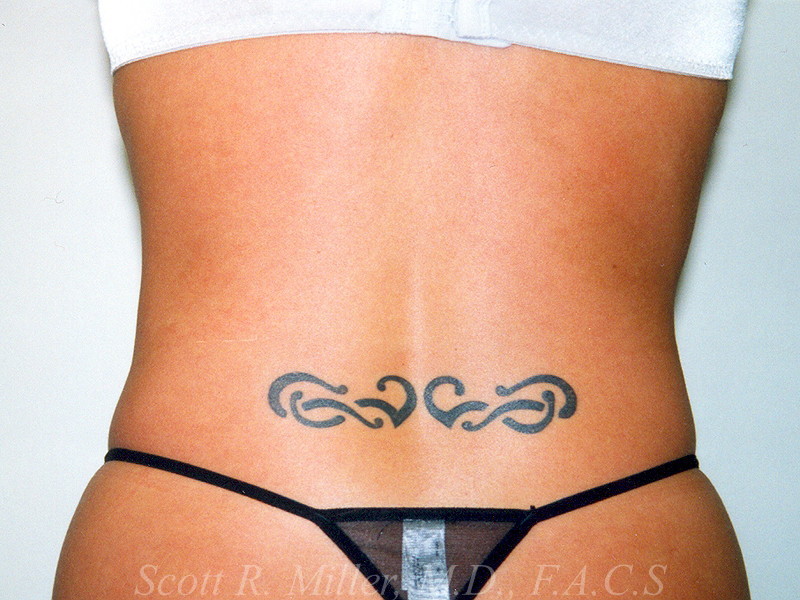 Liposuction before and after - after