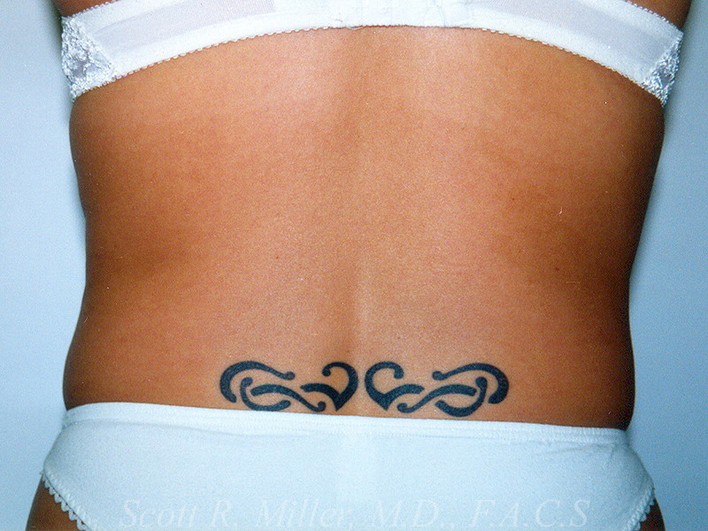 Liposuction before and after - before