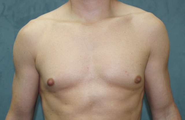 Gynecomastia Surgery before and after - after