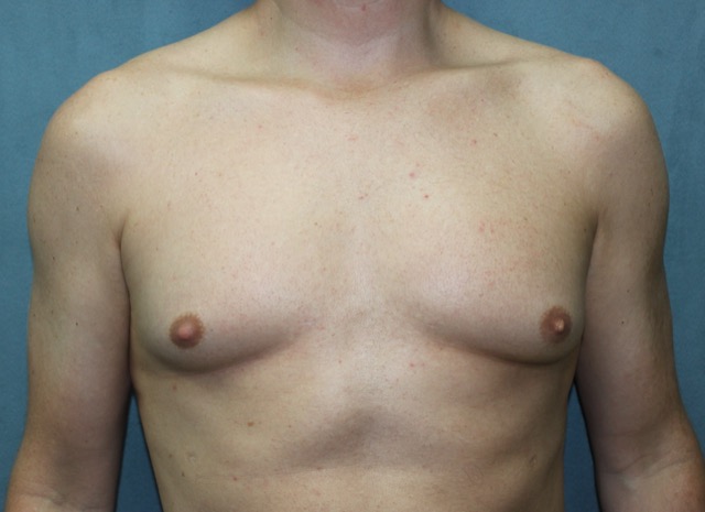 Gynecomastia Surgery before and after - before
