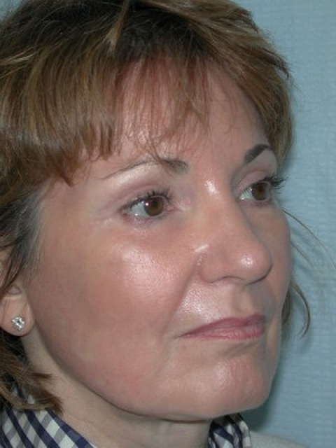 Blepharoplasty before and after - after