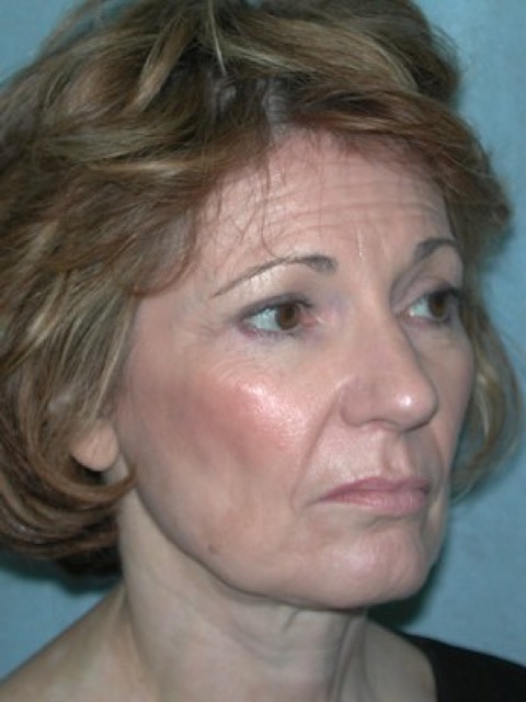 Blepharoplasty before and after - before