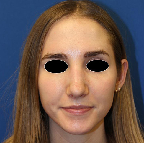 Rhinoplasty before and after - after