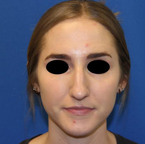 Rhinoplasty before and after - before