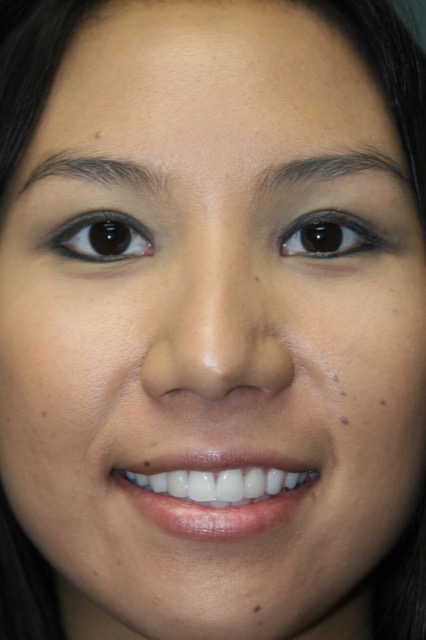 Blepharoplasty before and after - after