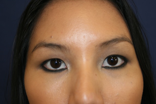 Blepharoplasty before and after - before