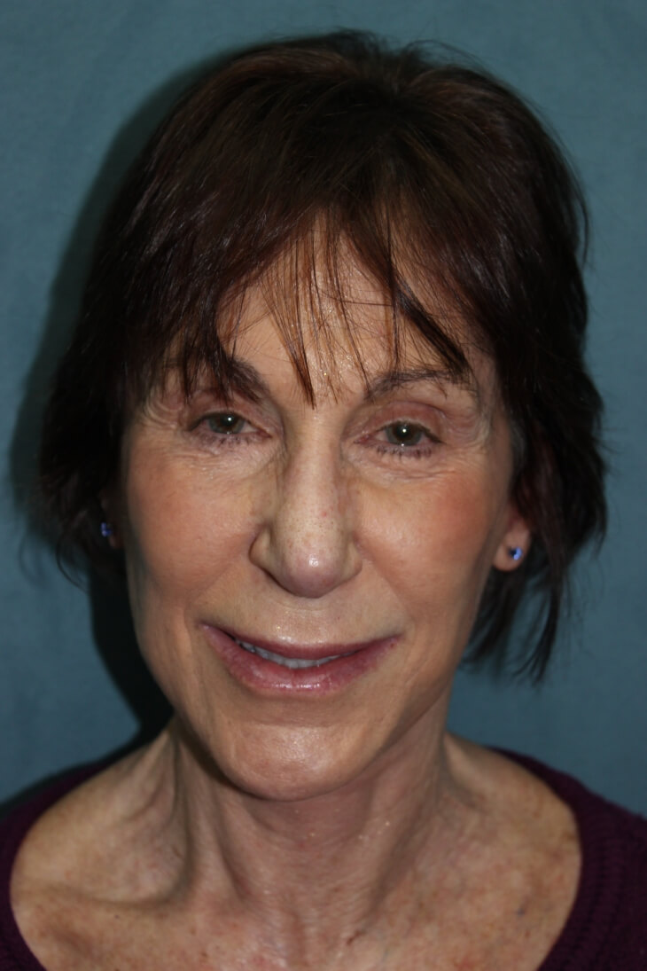 Facelift before and after - after