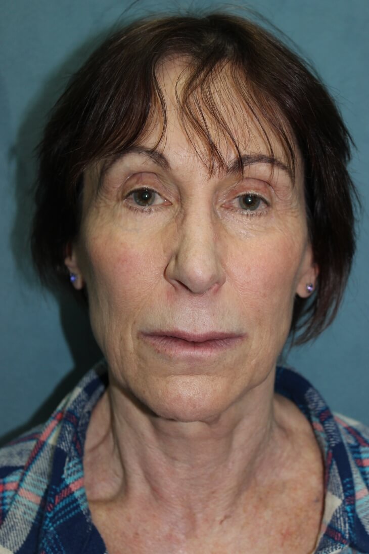 Facelift before and after - before