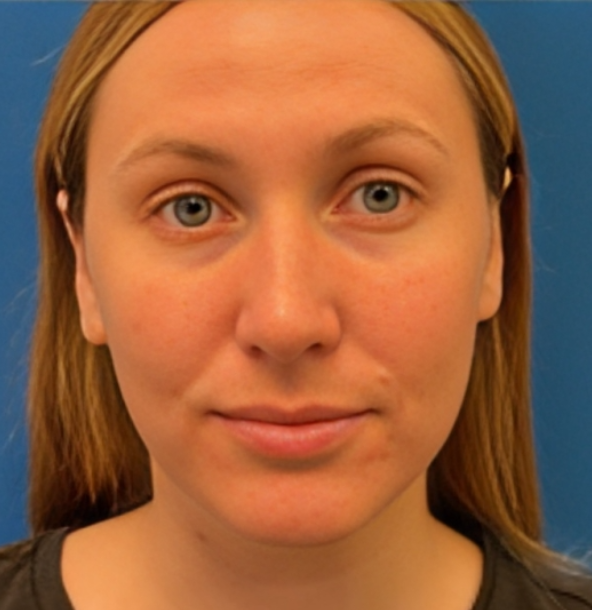 Rhinoplasty before and after - after