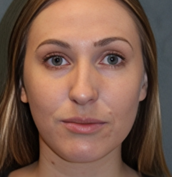 Rhinoplasty before and after - before