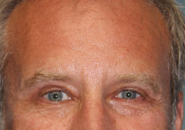 Blepharoplasty before and after - after