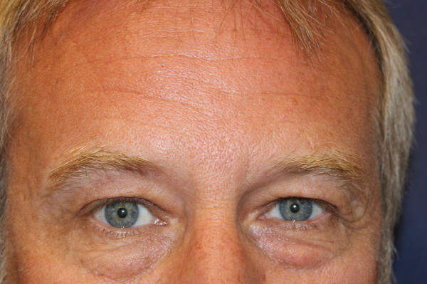 Blepharoplasty before and after - before