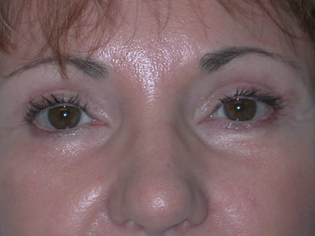 Blepharoplasty before and after - after