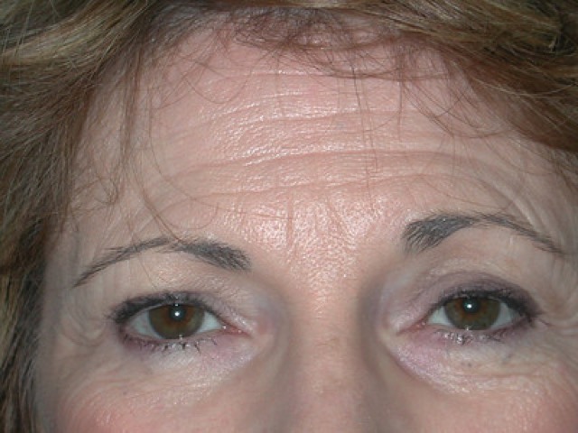 Blepharoplasty before and after - before