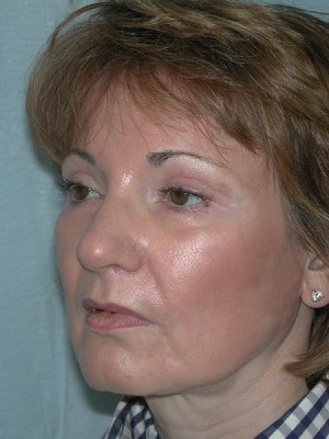 Blepharoplasty before and after - after