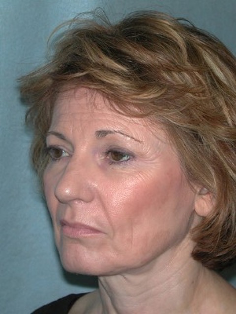 Blepharoplasty before and after - before