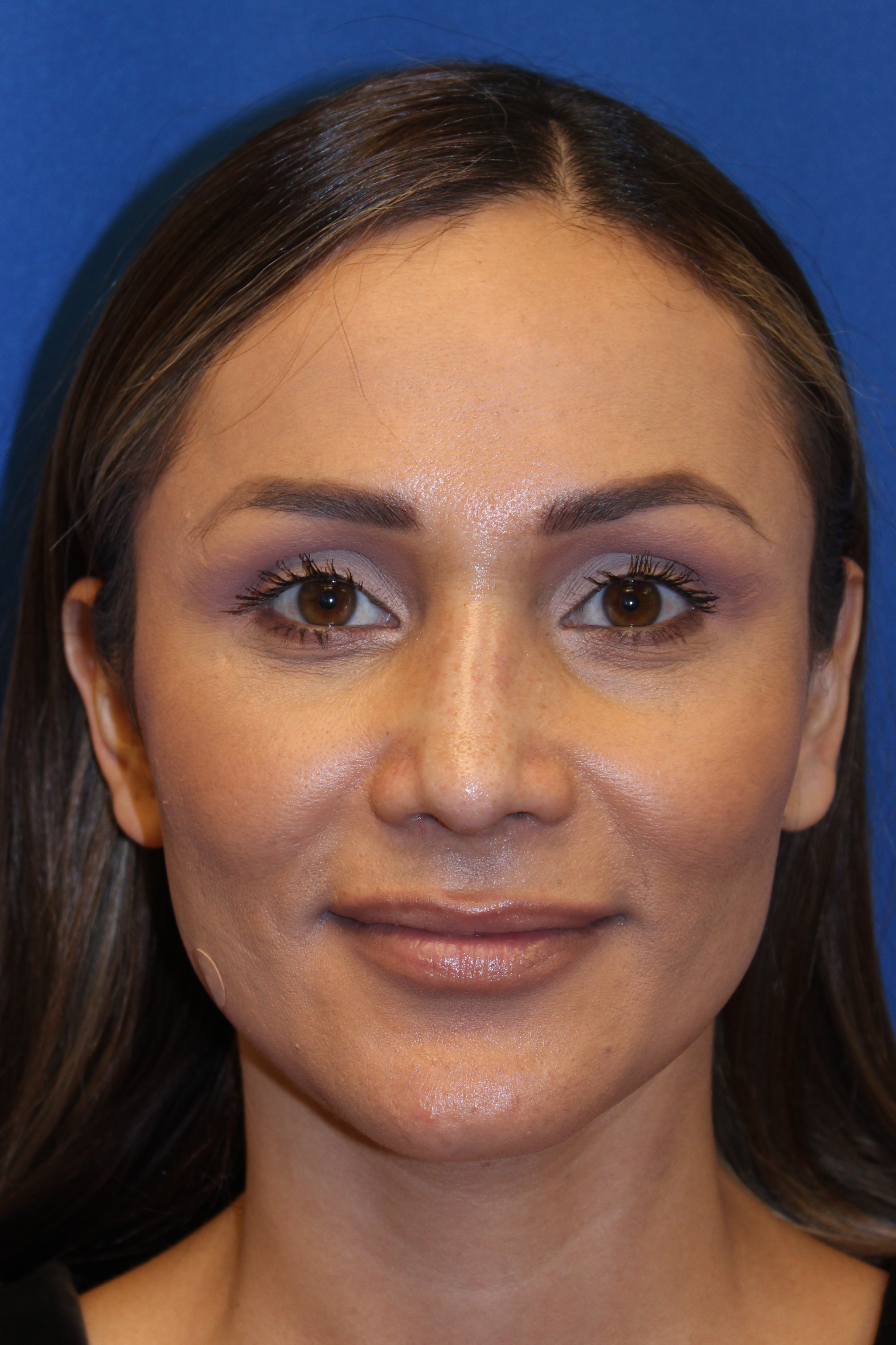 Rhinoplasty before and after - after