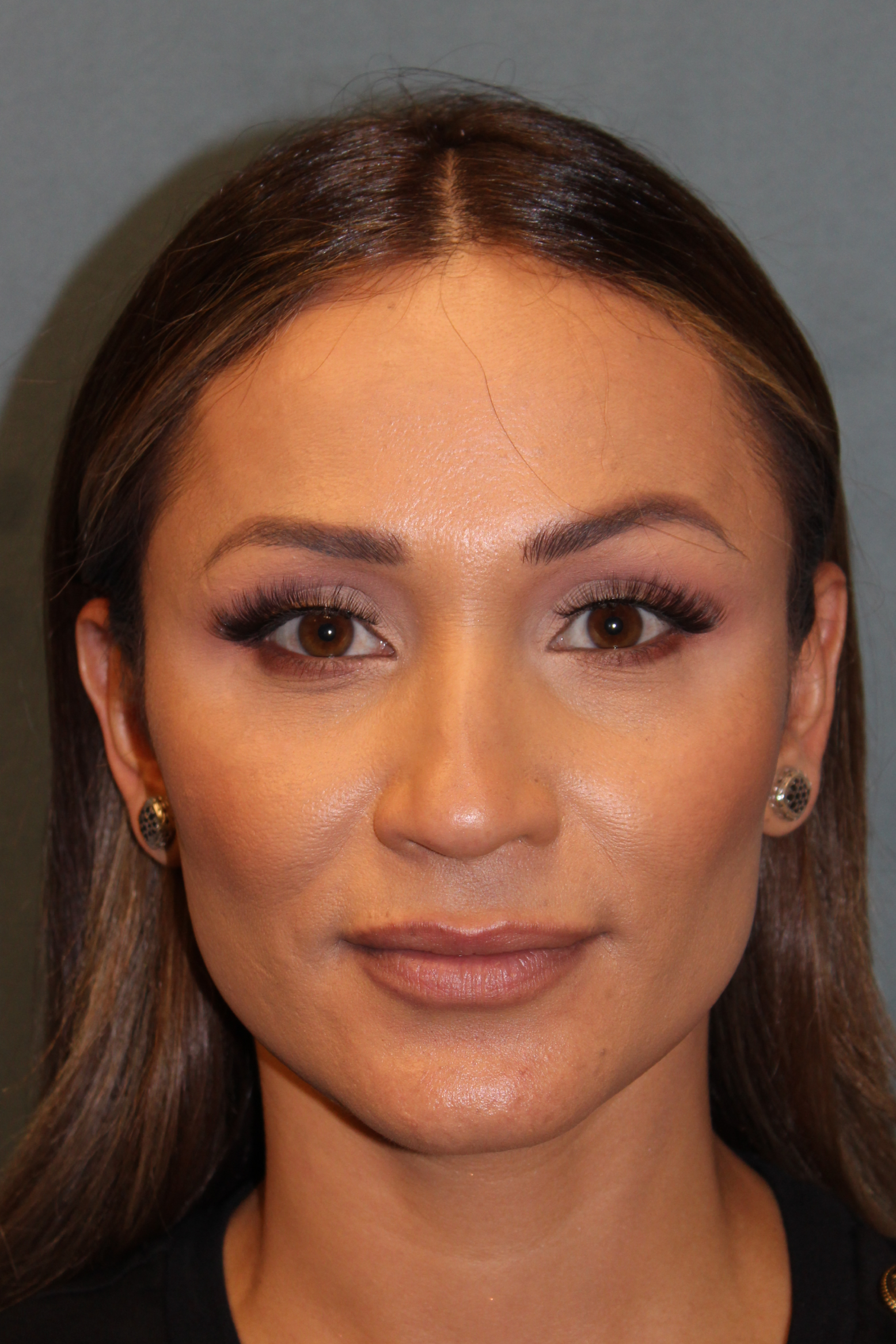 Rhinoplasty before and after - before