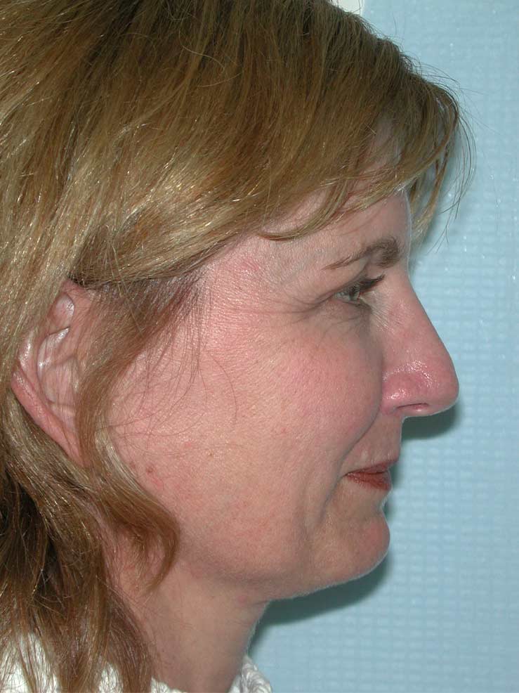 Blepharoplasty before and after - before