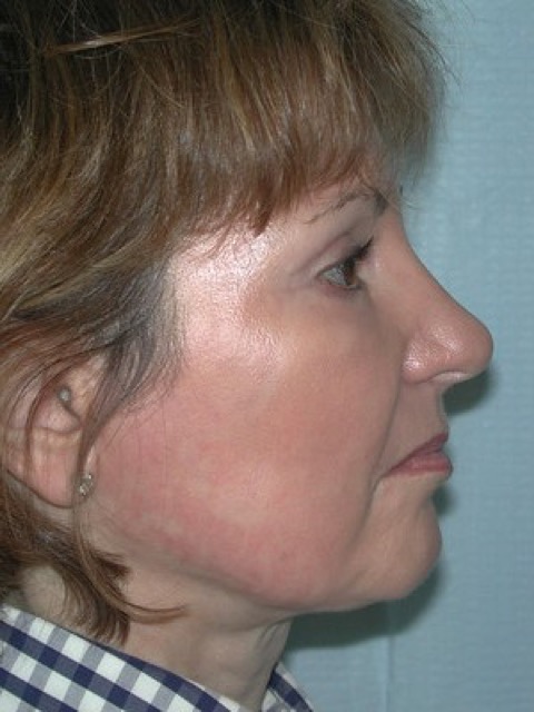 Blepharoplasty before and after - after