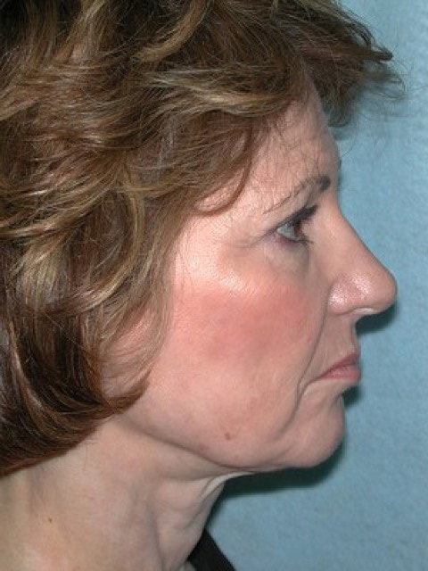 Blepharoplasty before and after - before