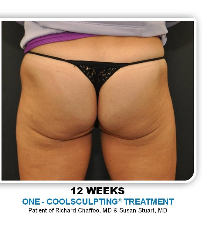 Coolsculpting before and after - after