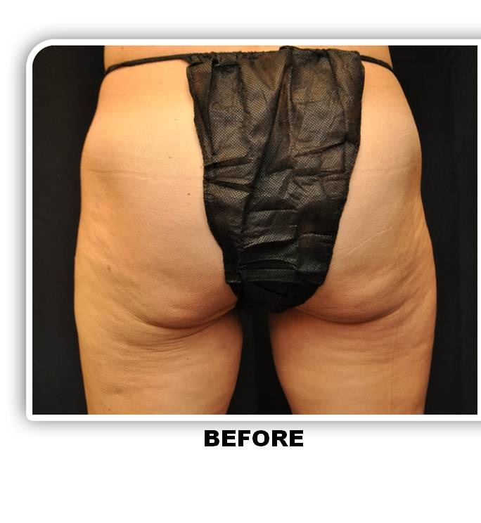 Coolsculpting before and after - before