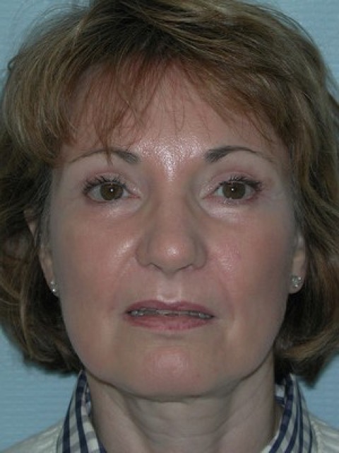 Blepharoplasty before and after - after