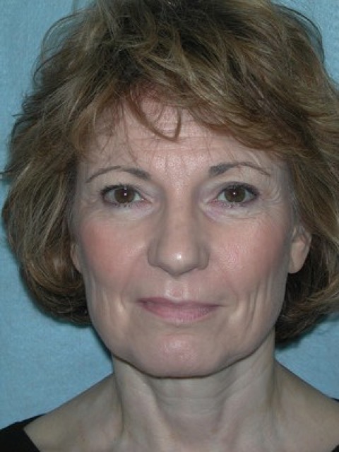 Blepharoplasty before and after - before