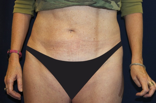 Tummy Tuck before and after - after
