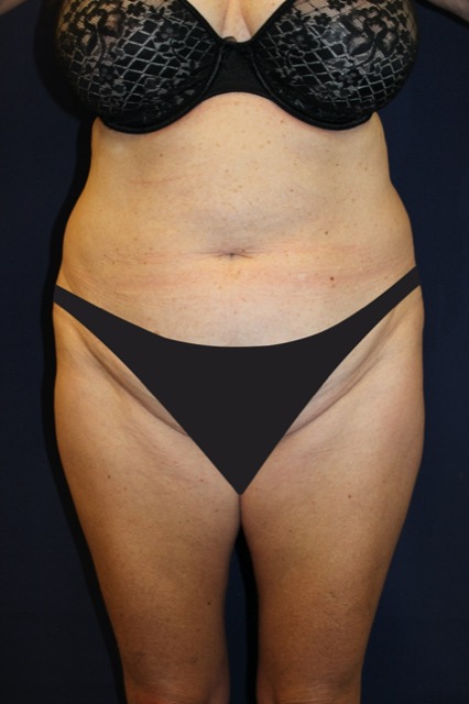 Tummy Tuck before and after - before