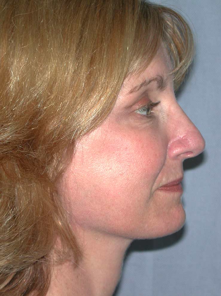 Blepharoplasty before and after - after