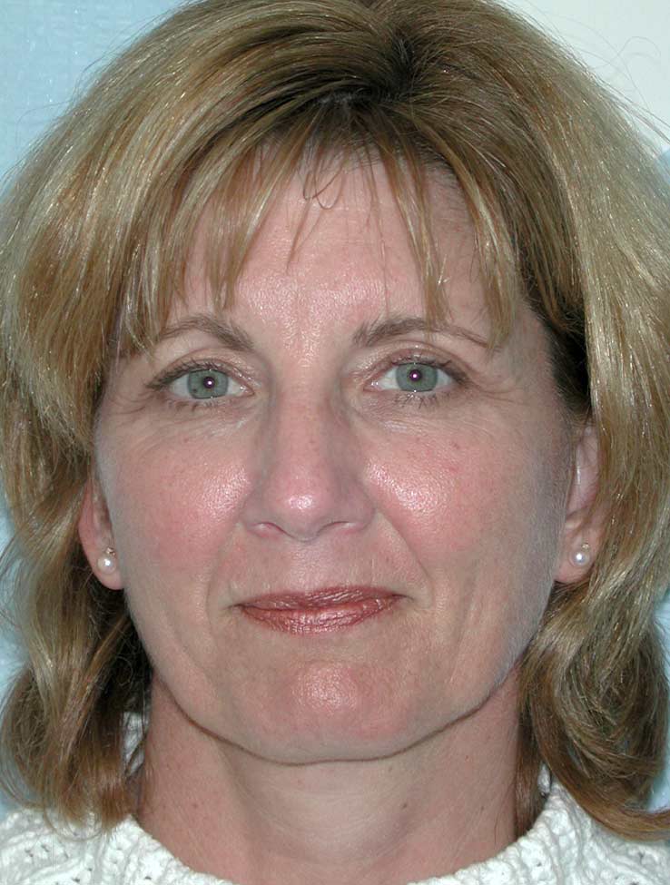 Blepharoplasty before and after - before