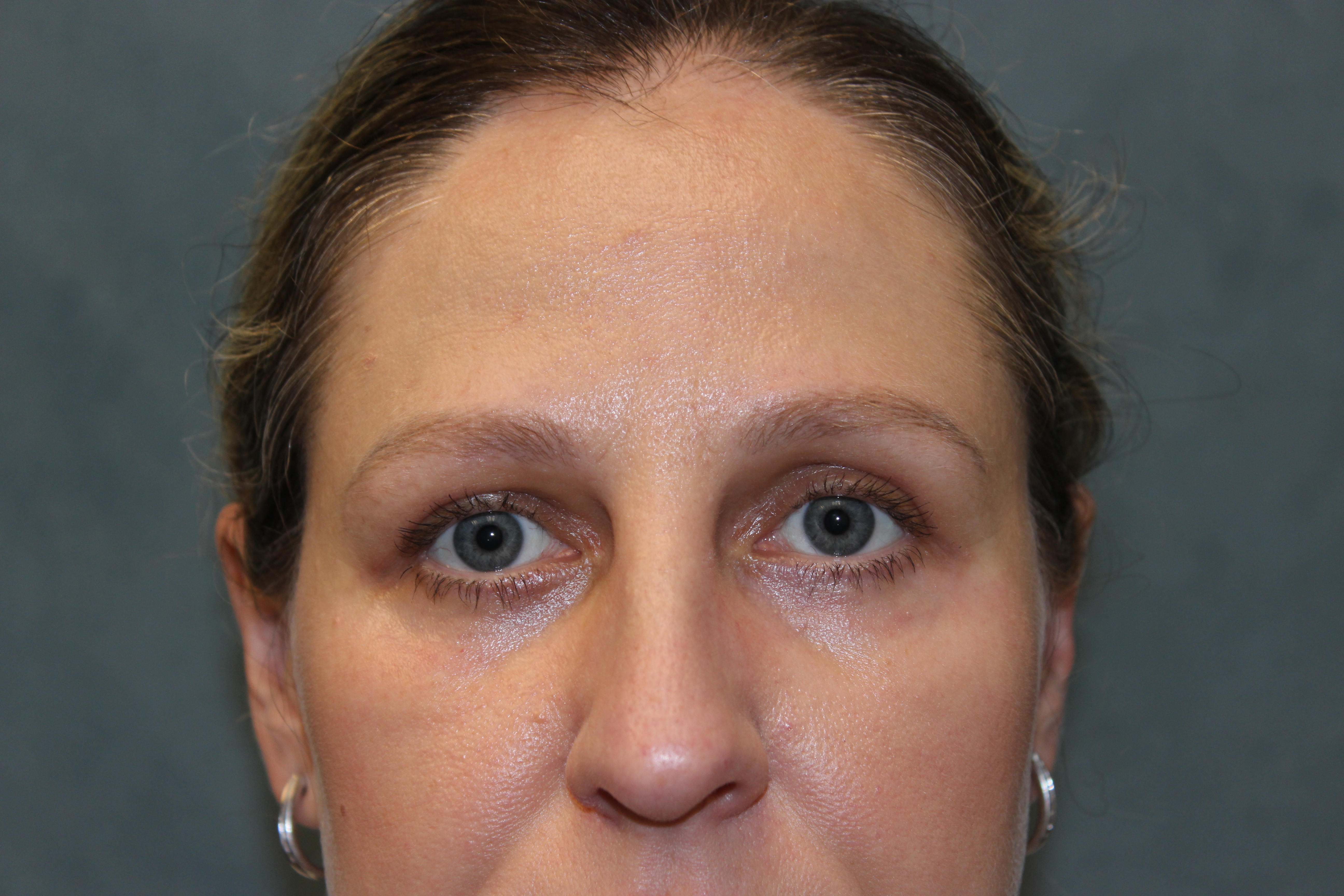 Blepharoplasty before and after - after
