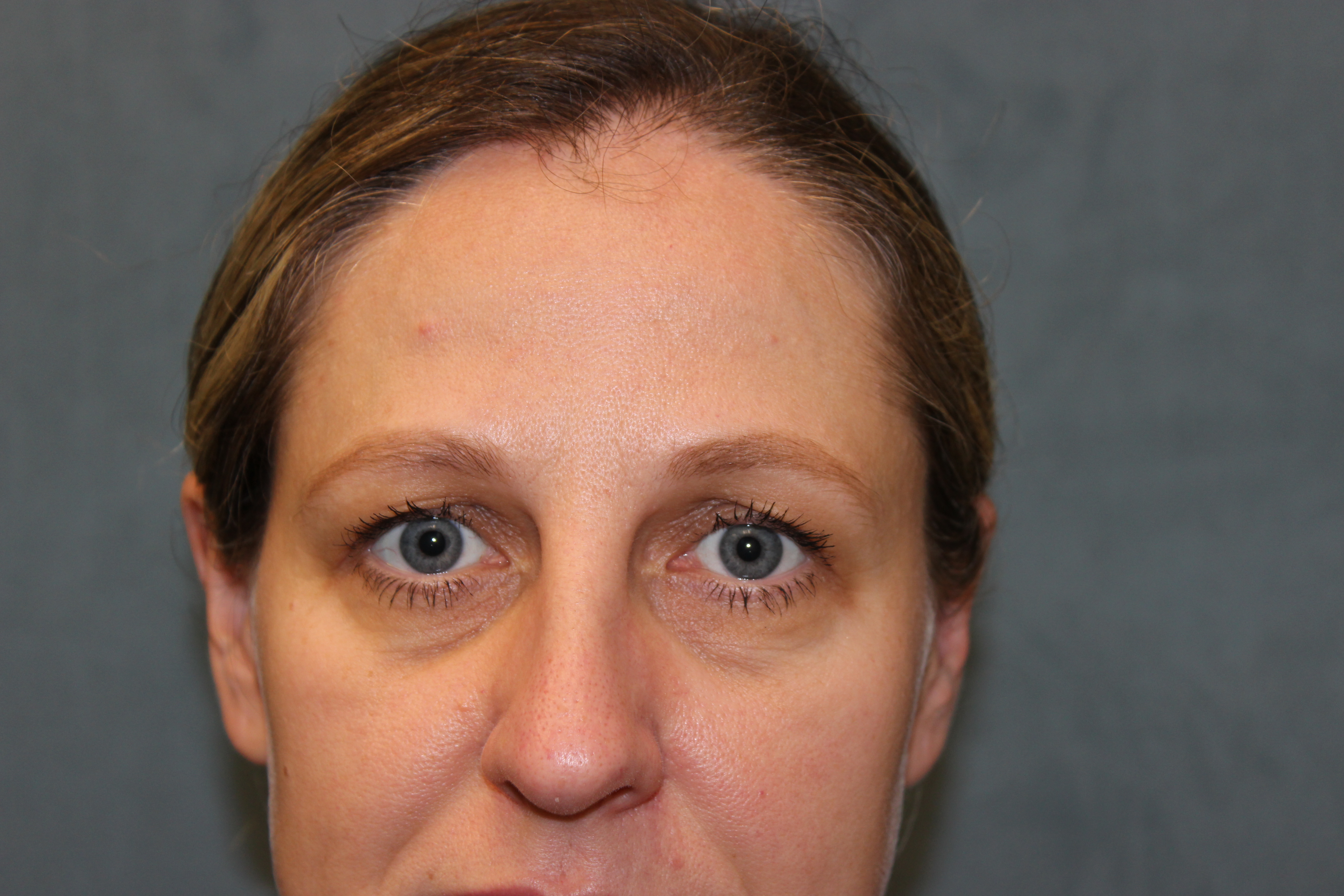 Blepharoplasty before and after - before