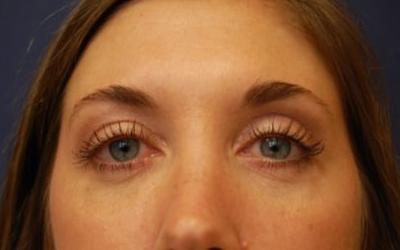 Blepharoplasty before and after - after