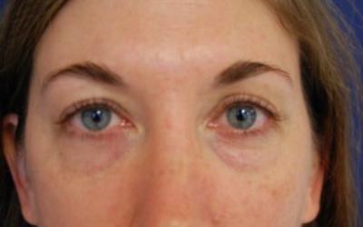 Blepharoplasty before and after - before