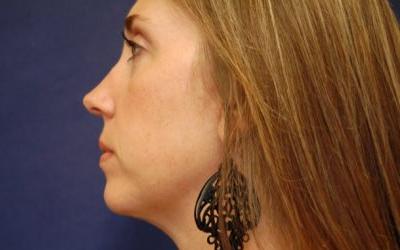 Blepharoplasty before and after - after