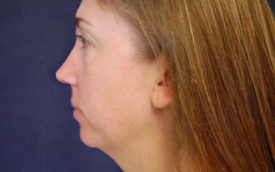 Blepharoplasty before and after - before