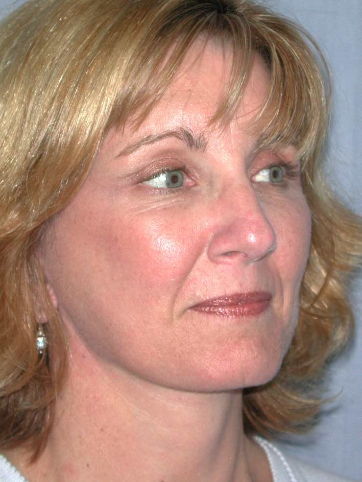Blepharoplasty before and after - after