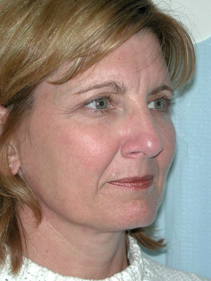 Blepharoplasty before and after - before